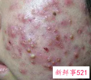 用什么可以去脸上的痘痘