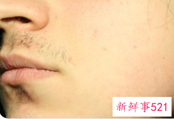 脸上总长粉刺怎么治疗