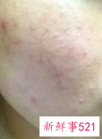 用什么可以去脸上的痘痘