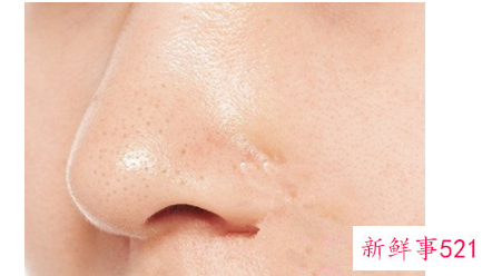 如何去除烦人的草莓鼻