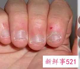 孩子老是啃手指头怎么办