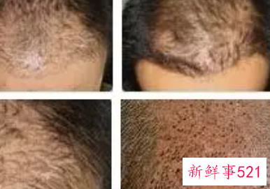 植发的风险与危害