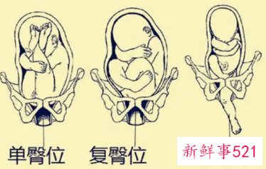 胎儿臀位孕妇少坐会怎么样