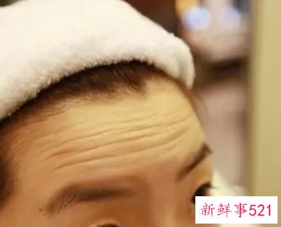 永久去抬头纹手术多少钱