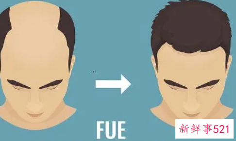 植发的风险与危害