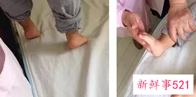 婴儿脑瘫的治疗方法有哪些