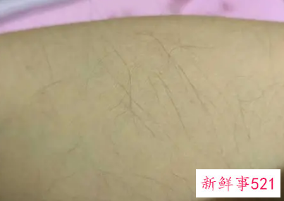 梦见胳膊长毛是什么意思