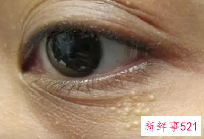 眼皮上的脂肪粒怎么去除