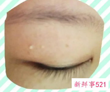 眼皮上的脂肪粒怎么去除
