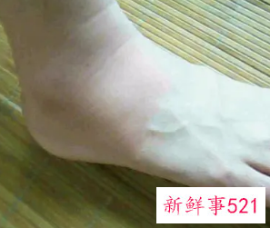 梦见脚上长个大包