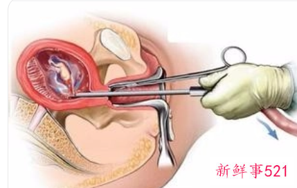吃药流产好还是无痛人流好