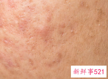 色素沉着会自愈吗