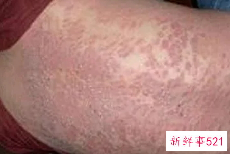 治牛皮癣偏方这13个省钱又高效