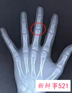 骨龄偏大可以降下来