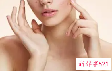 祛痘痕最有效的方法