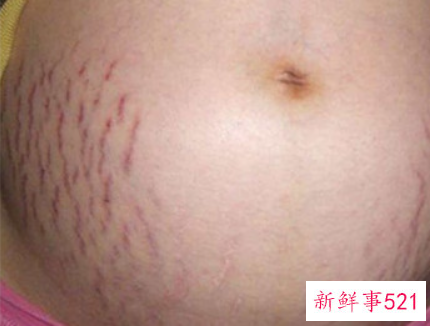 妊娠纹怎么消除效果好