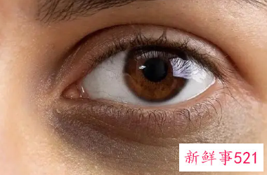 出现黑眼圈怎么办好