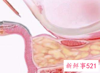 眼皮下垂怎么改善最有效