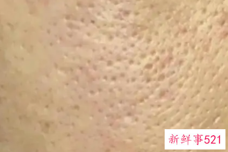 毛孔粗大是什么原因造成的呢