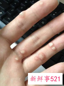 手指上有凸起的小疙瘩