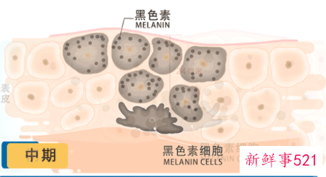 黄褐斑爬上脸女人该如何祛斑