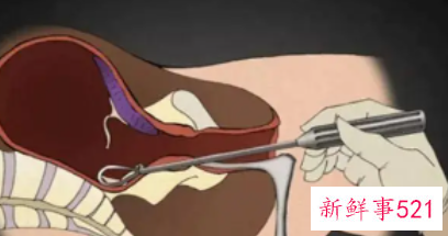 梦见做了子宫手术寓意