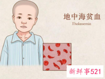 重度地贫胎儿症状