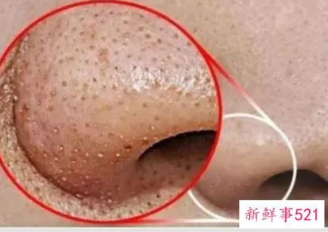 螨虫和痘痘的区别