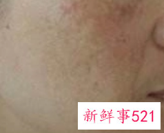 如何能去掉蝴蝶斑