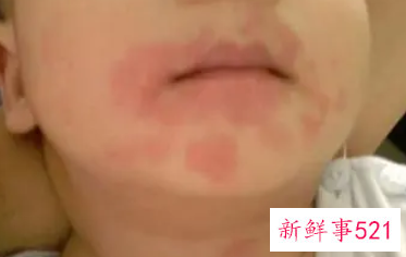 肌肤过敏征兆如何正确护理