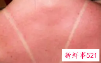 孩子脸上皮肤晒伤