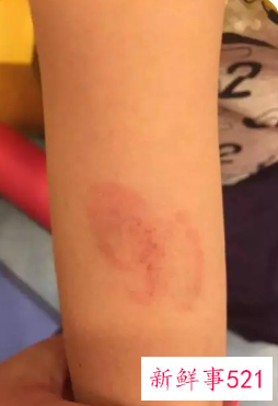 去除摔伤黑印的偏方