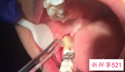 拔牙后该如何护理伤口