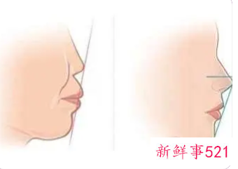 口呼吸20岁了还能矫正回来脸型吗