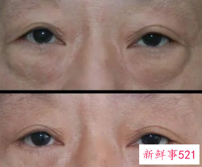 中老年治疗眼袋最有效的方法