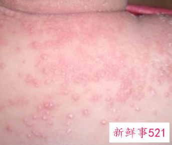 婴儿湿疹怎么根治