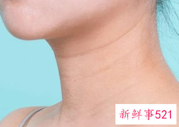 怎样可以改善颈纹