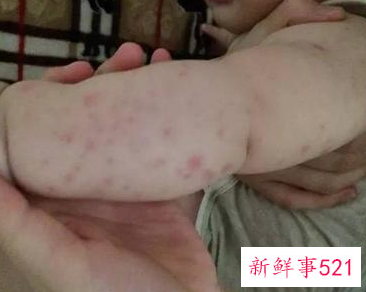 螨虫叮咬后的症状图