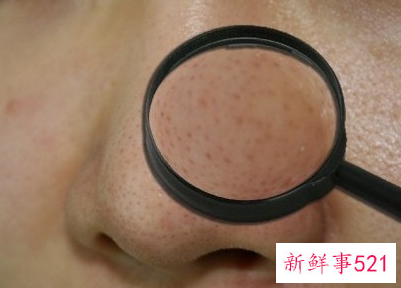 激光治疗毛孔粗大需要多少次美容