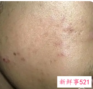 顽固的痘印用什么去除