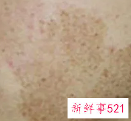 怎么去黑斑呢