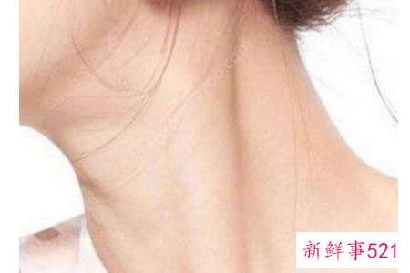 颈部有皱纹怎么办