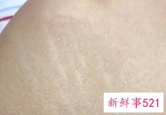 白色的是肥胖纹还是生长纹