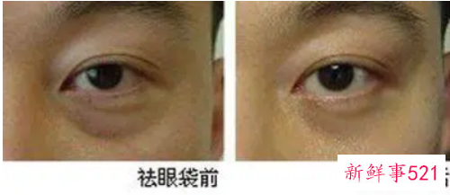 不手术去眼袋的方法如下