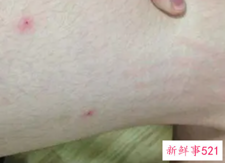 螨虫叮咬后的症状图