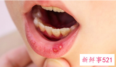 女性缺乏维生素b2的典型症状是什么