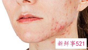 青春期脸上长痘痘怎么调理