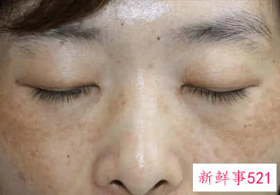 雀斑如何淡化雀斑小窍门