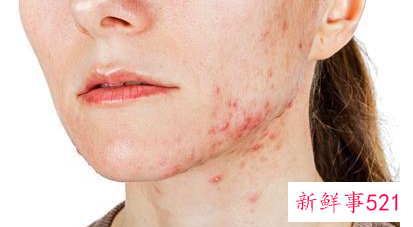 青春痘怎么消除