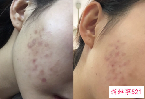 痘印怎么消得快一点